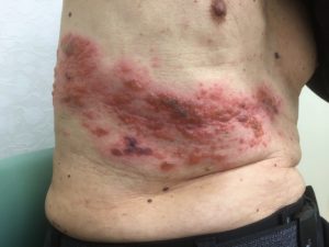 Herpes-zoster na barriga abdomem e costas
