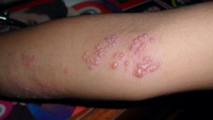 Herpes-zoster no cotovelo e braço