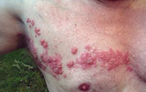 Herpes-zoster no peito e axilas