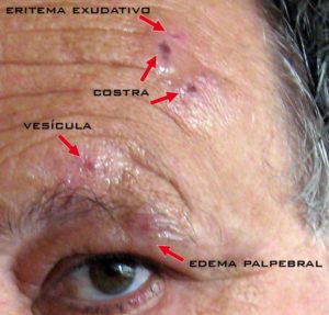 Herpes-zoster oftalmico no rosto olhos e testa